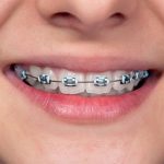 Sebagai Aksesori: Behel Gigi Menjadi Gaya Hidup Gen Z