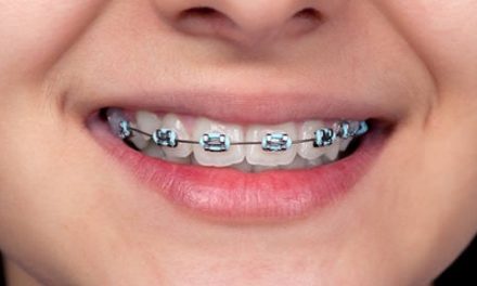 Sebagai Aksesori: Behel Gigi Menjadi Gaya Hidup Gen Z