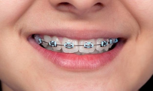 Sebagai Aksesori: Behel Gigi Menjadi Gaya Hidup Gen Z