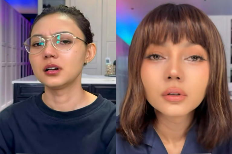 Rina Nose Akui Depresi Pasca Oplas Hidung